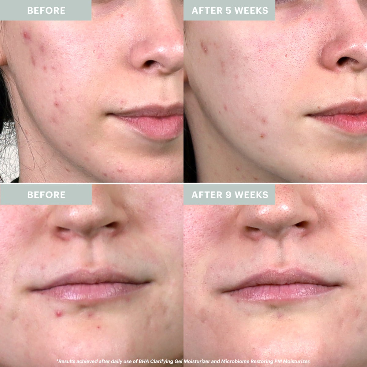 Close-up before/after cheeks and mouth labeled BEFORE; AFTER 5 WEEKS; AFTER 9 WEEKS showing reduced acne and smoother skin.