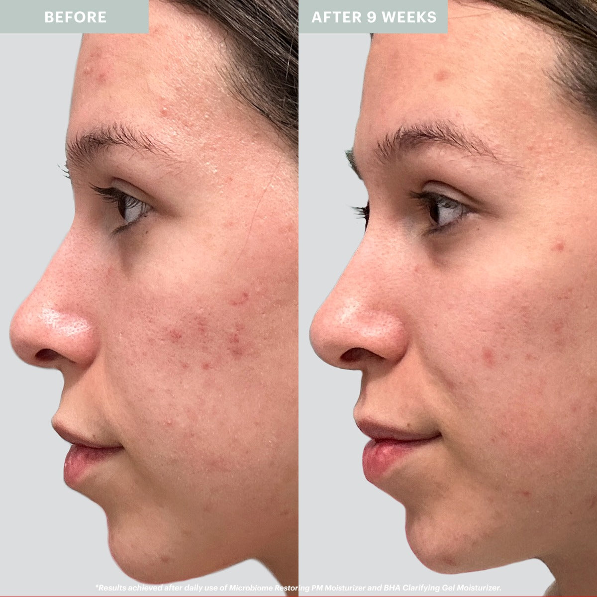 Side-by-side profile photos showing skin improvement after 9 weeks using Microbiome Restoring PM Moisturizer, with text 'BEFORE' and 'AFTER 9 WEEKS'.
