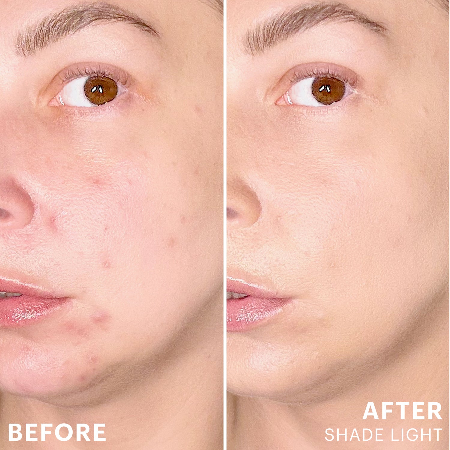 Split BEFORE and AFTER comparison of cheek acne coverage with Spot Treat Concealer, SHADE LIGHT.