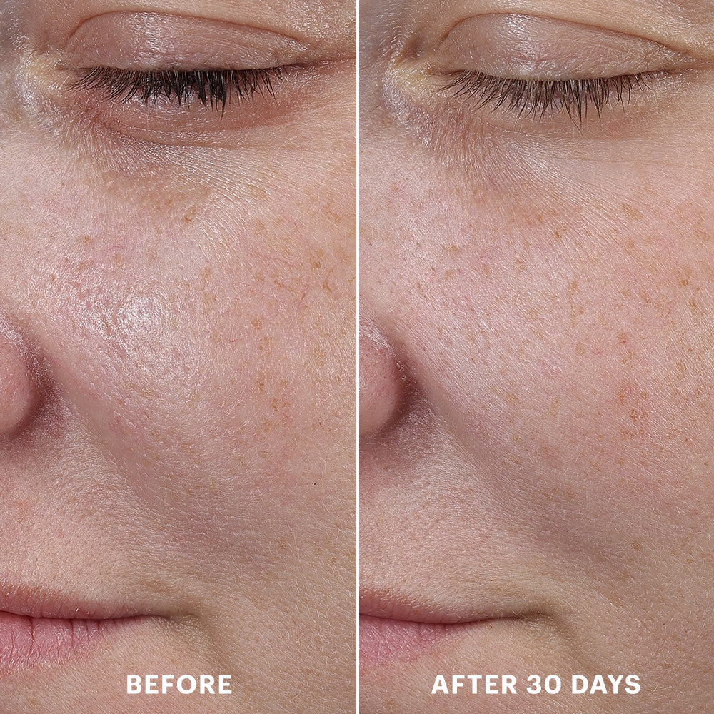 Close-up side-by-side comparison of cheek skin before and after 30 days showing reduced redness and smoother texture