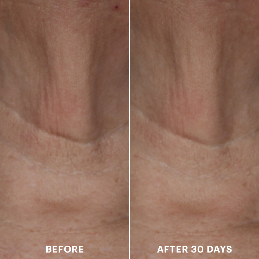 Split close-up of neck wrinkles, left labeled 'BEFORE' and right labeled 'AFTER 30 DAYS' showing reduced lines.