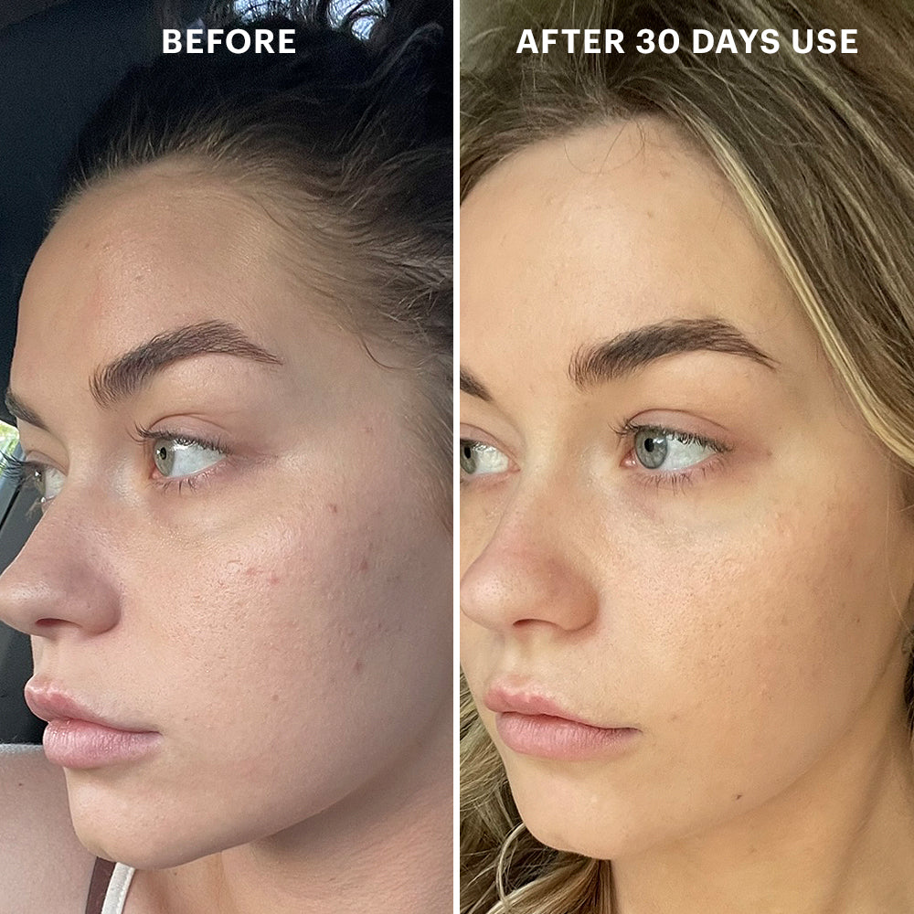 Side-by-side facial photos labeled BEFORE and AFTER 30 DAYS USE showing reduced blemishes and smoother skin.
