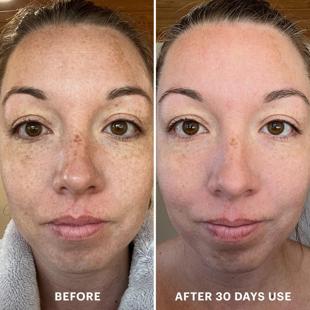 Woman's face before and after 30 days using Bio-Renew EGF Cream, showing reduced freckles and clearer skin. 