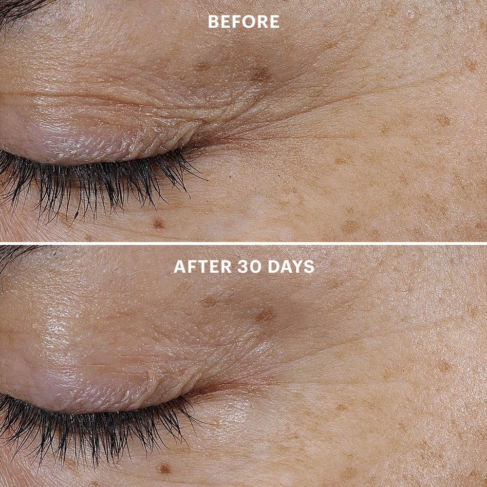 Closed eye close-up showing reduced wrinkles and brown spots; labeled 
