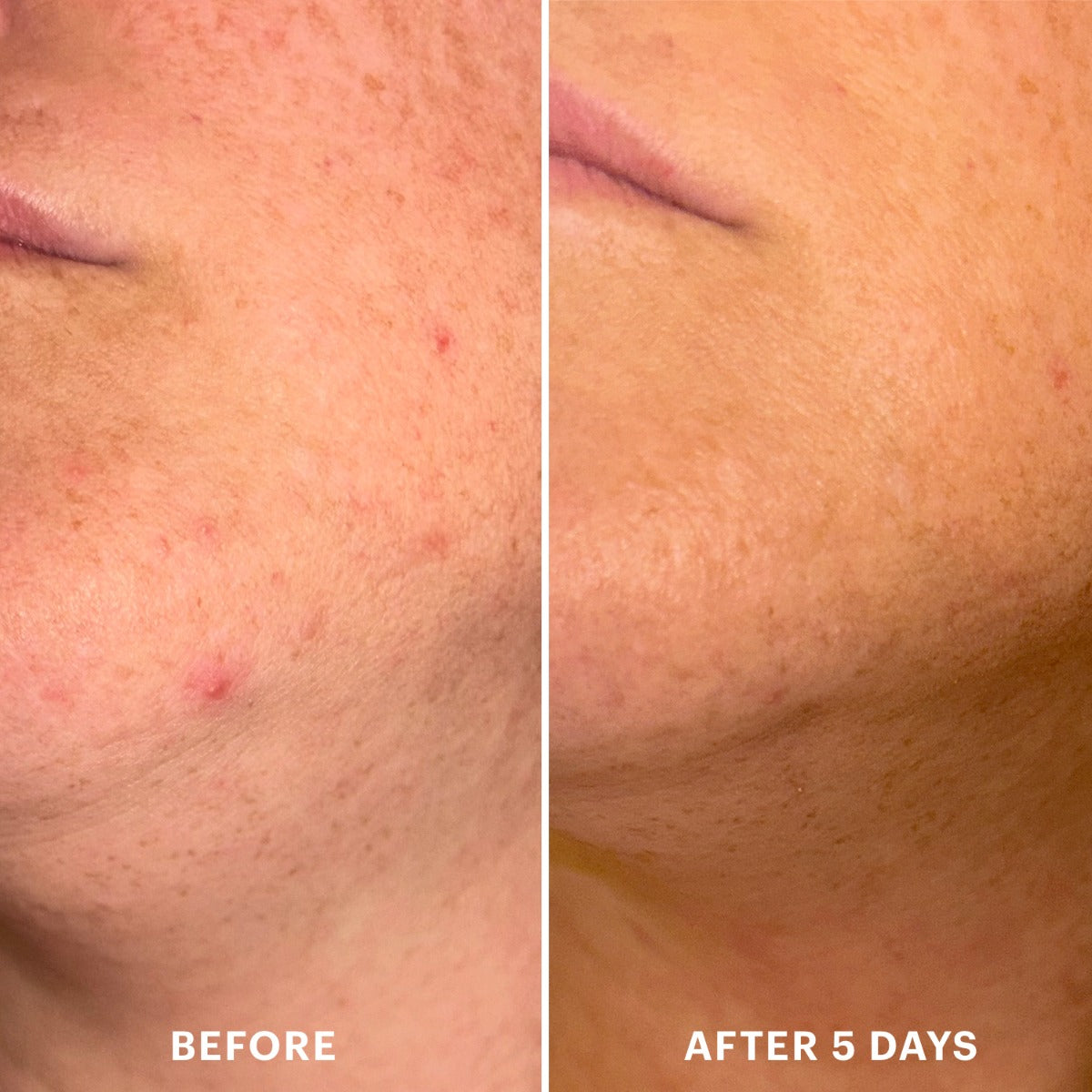 Close-up of cheek showing acne before and clearer skin after 5 days