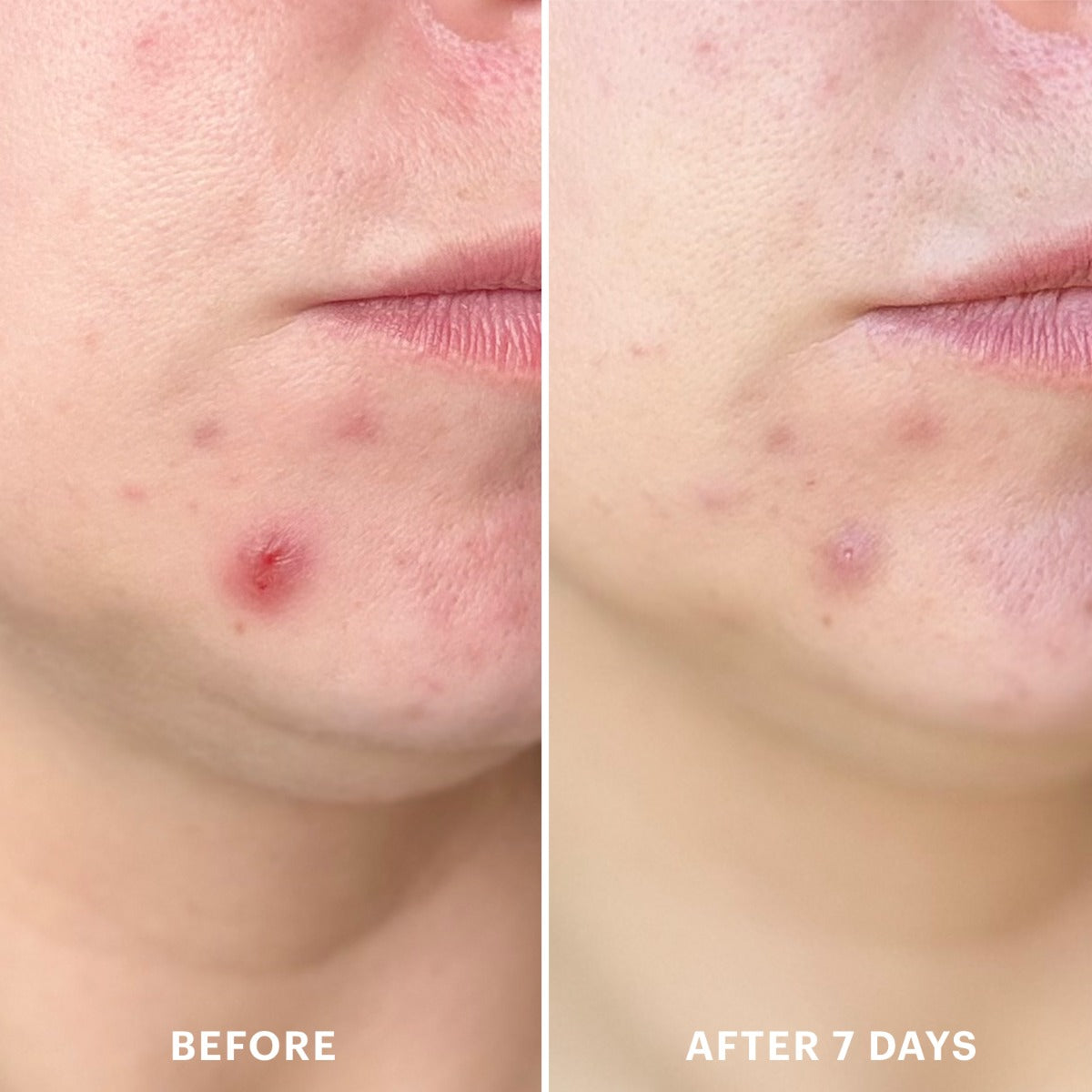 Close-up before-and-after photos of a chin showing acne healing over 7 days, labeled BEFORE and AFTER 7 DAYS.