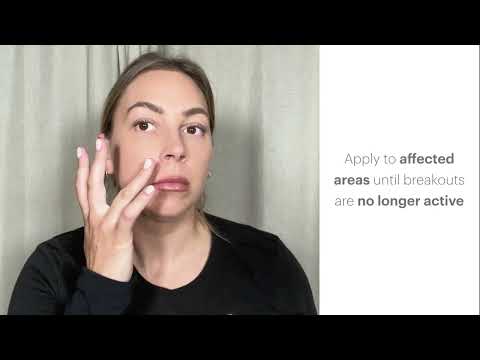 Acne Spot Treatment